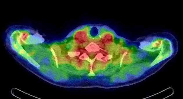 Obr.2.: SPECT/CT v axi�ln�m �ezu - zv��en� krevn� pool v obou AC sklouben�ch.