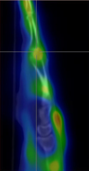 Obr.1.: SPECT/CT v sagit�ln�m �ezu - zv��en� krevn� pool v oblasti MCP kloubu III. prstu LHK.