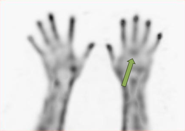 Obr.2.: SPECT v MIP projekci -  zv��en� krevn� pool v oblasti MCP kloubu III. prstu LHK.