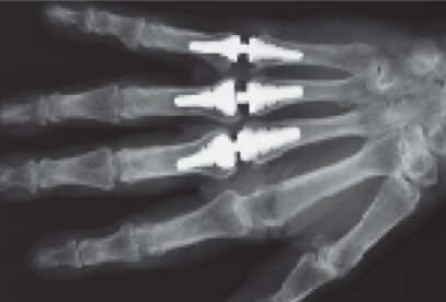 Obr. č. 2: Rtg snímek ruky pacienta s kloubními implantáty III. až V. MCP kloubu.