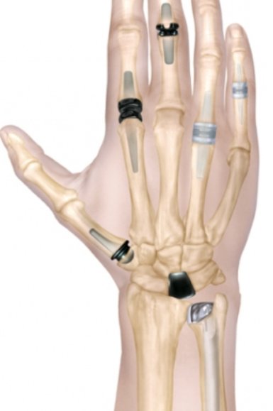 Obr. 3: Varianty endoprotéz ručních kloubů.
