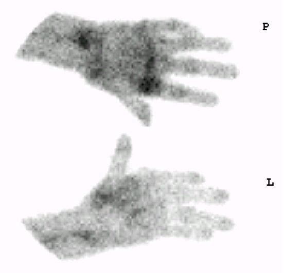 Obr. 5: Vyšetření ze září 2015 - sumační scintigram rukou v perfuzní fázi.