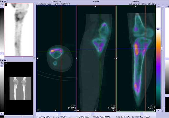 Obr. . 10: Fze obraz SPECT a CT.  Zameno na tet loisko vproximln sti prav tibie. ez transverzln, sagitln a koronln.