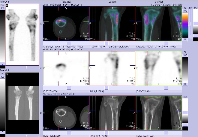 Obr. . 4: Fze obraz SPECT a CT.  Zameno na loisko vproximln sti prav tibie. ez transverzln, sagitln a koronln.