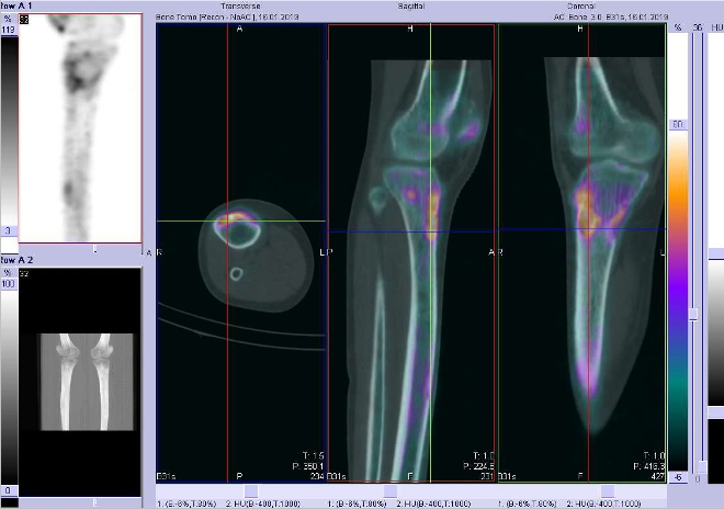 Obr. . 5: Fze obraz SPECT a CT.  Zameno na loisko vproximln sti prav tibie. ez transverzln, sagitln a koronln.
