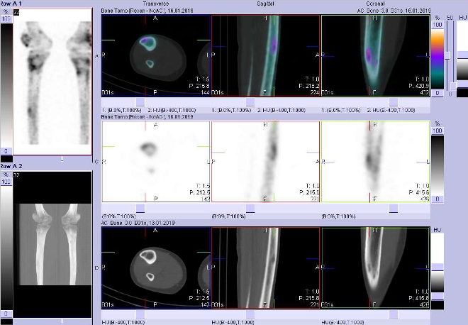 Obr. . 7: Fze obraz SPECT a CT.  Zameno na loisko vdiafze prav tibie. ez transverzln, sagitln a koronln.