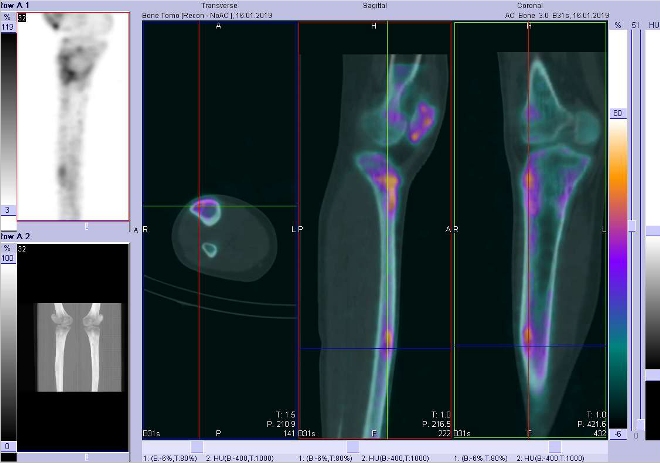 Obr. . 8: Fze obraz SPECT a CT.  Zameno na loisko vdiafze prav tibie. ez transverzln, sagitln a koronln.