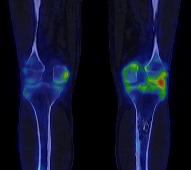 Obr.2.: Fze obraz SPECT/CT v pozdn fzi - morfologicky patrn lze je bez zven akumulace radiofarmaka, vy akumulace radiofarmaka je pouze v kolennch kloubech s koreltem degenerativnch zmn.