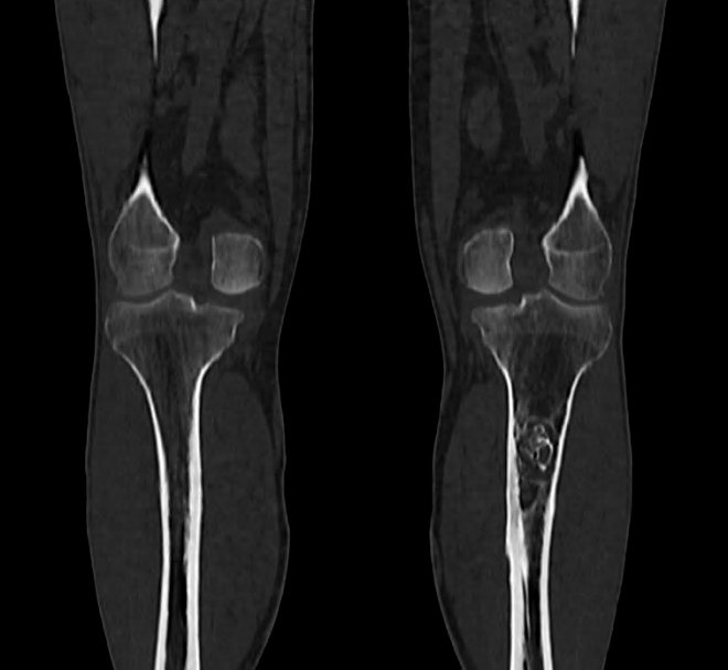 Obr.3.: Na low dose CT loisko nepravideln sklerotizace imponujc v diferenciln diagnostice jako enchondrom.