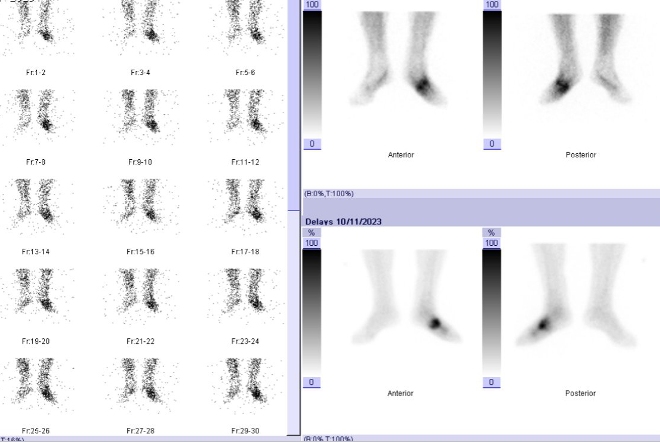 Obr. . 1: Tfzov scintigrafie skeletu nohou a distln sti brc.
