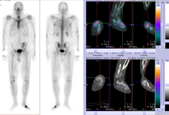 Obr. . 2: Celotlov scintigrafie a fze obraz SPECT a CT.  Zameno na loisko v lev noze.