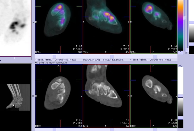Obr. . 3-7: Fze obraz SPECT a CT.  Zameno na loiska v lev noze.