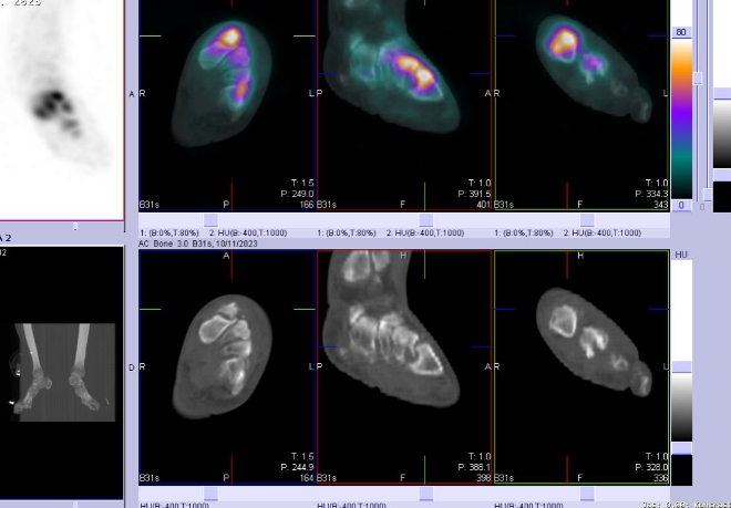 Obr. . 3-7: Fze obraz SPECT a CT.  Zameno na loiska v lev noze.