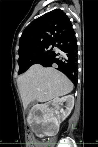 Obr. . 1-5: CT hrudnku, bicha a pnve, patrn expanze prav ledviny, plicn metastzy, lytick metastza v prav kyeln kosti.