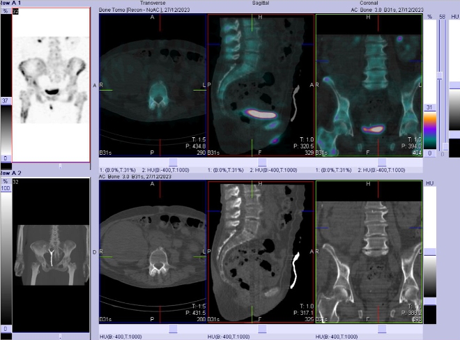Obr. . 8-10: Fze obraz SPECT a CT bedern ptee, pnve, kyelnch kloub, proximln sti stehennch kost.