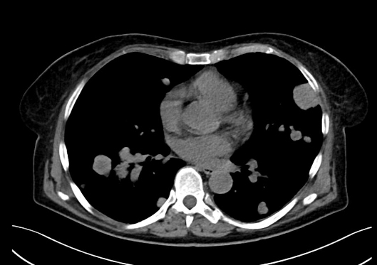 Obr. . 1-5: CT hrudnku, bicha a pnve, patrn expanze prav ledviny, plicn metastzy, lytick metastza v prav kyeln kosti.