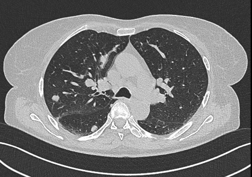 Obr. . 1-5: CT hrudnku, bicha a pnve, patrn expanze prav ledviny, plicn metastzy, lytick metastza v prav kyeln kosti.