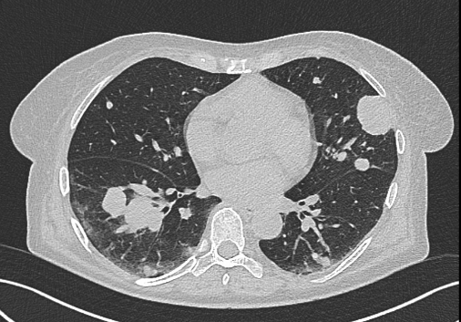 Obr. . 1-5: CT hrudnku, bicha a pnve, patrn expanze prav ledviny, plicn metastzy, lytick metastza v prav kyeln kosti.