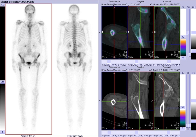 Obr. . 6: Celotlov scintigrafie a SPECT/CT pnve, kyl a proximln sti stehennch kost.