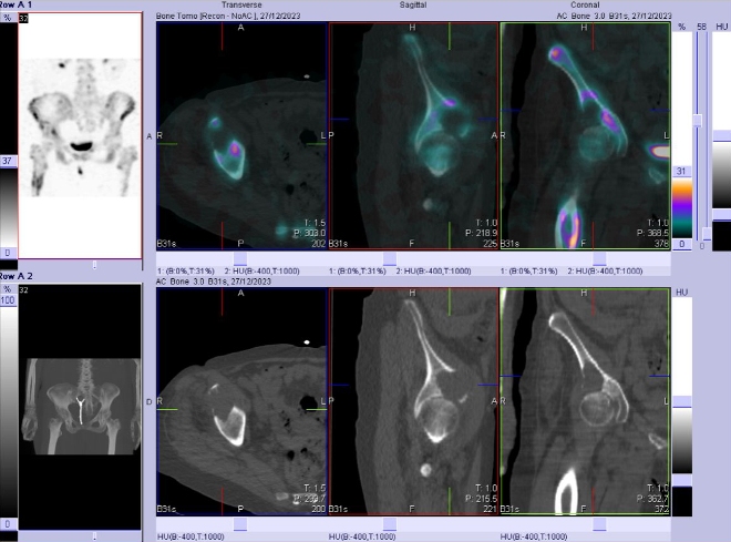 Obr. . 7: Fze obraz SPECT a CT pnve. Lytick loisko v prav kyeln kosti.