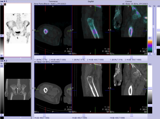 Obr. . 8: Fze SPECT/CT bicha a pnve 24 hod. po aplikaci OctreoScanu. Zameno na loisko v levm jaternm laloku.