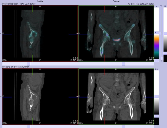 Obr. . 9: Fze SPECT/CT bicha a pnve 24 hod. po aplikaci OctreoScanu. Zameno na loisko v kaud pankreatu.