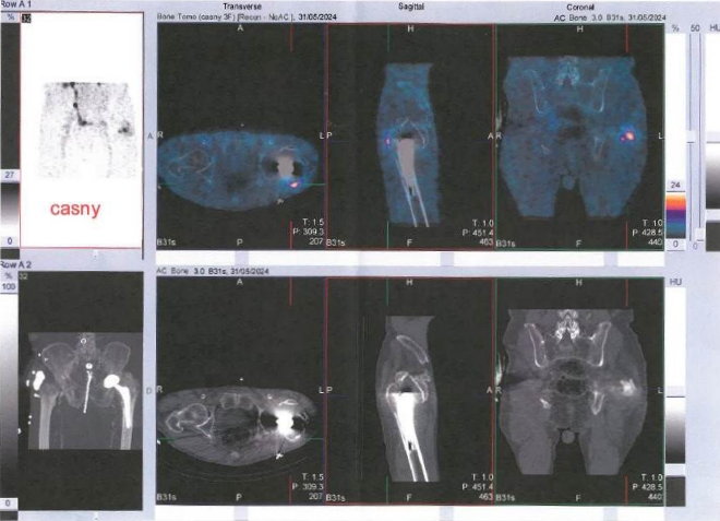 Obr. č. 2: Časný SPECT/CT kyčlí.