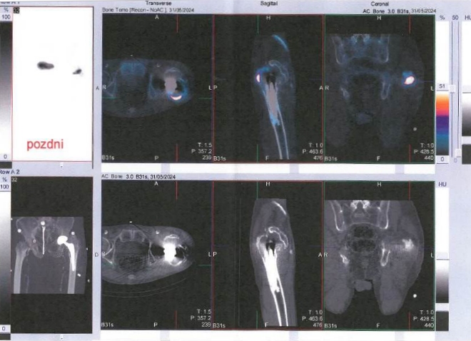 Obr. č. 3: Pozdní SPECT/CT kyčlí.