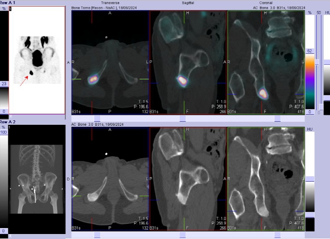 Obr. �. 2: F�ze obraz� SPECT a CT p�nve. Lo�isko v prav� sedac� kosti.