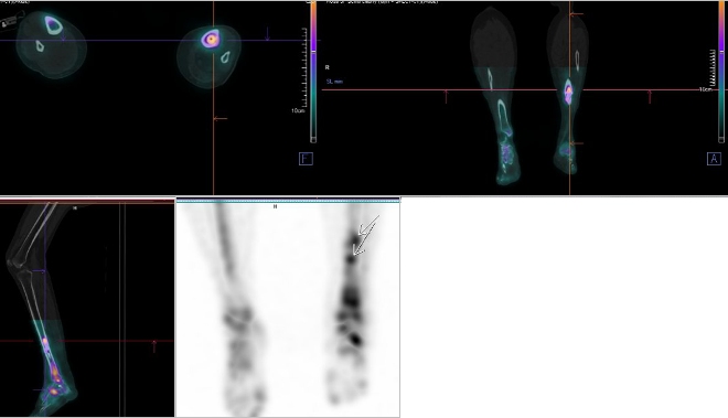Obr. č. 5: Pozdní SPECT/CT nohou a bérců.