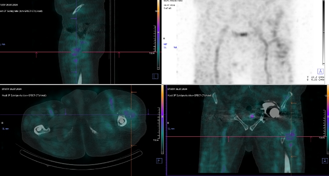 Obr. č. 2: Časný SPECT/CT kyčlí.
