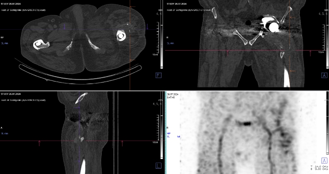 Obr. č. 3: Časný SPECT/CT kyčlí.