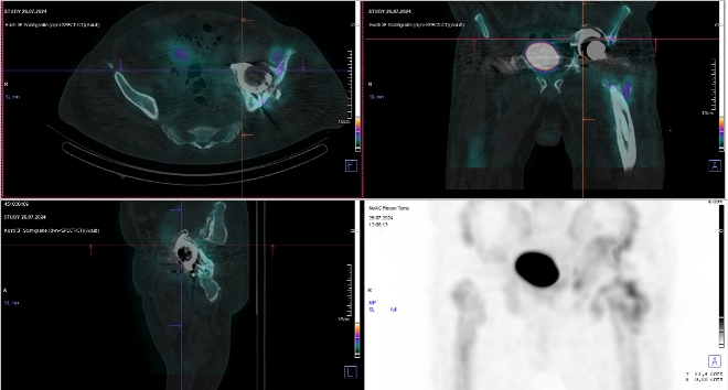 Obr. č. 4: Pozdní SPECT/CT kyčlí.