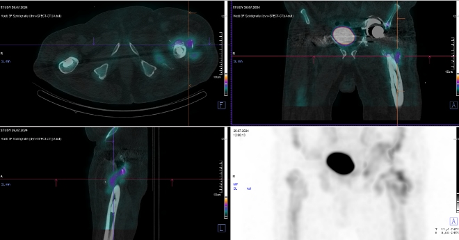 Obr. č. 5: Pozdní SPECT/CT kyčlí.
