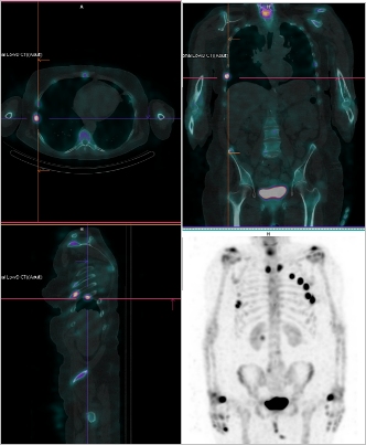 Obr.č.2: Fúze obrazů SPECT a CT. Zaměřeno na ložisko v žebru.