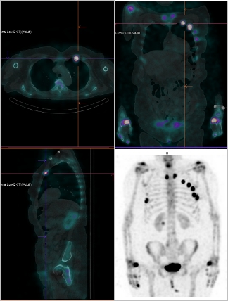 Obr. č. 3: Fúze obrazů SPECT a CT. Zaměřeno na ložisko v žebru.
