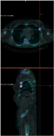 Obr. č. 6: Fúze SPECT a CT. Zaměřeno na ložisko v žebru.