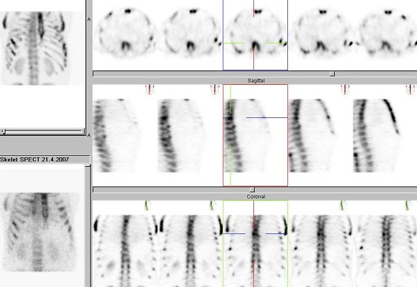 Obr. č. 2: Tomografická scintigrafie (SPECT) skeletu hrudníku. Vpravo v horním řádku řezy transverzální, v prostřední řadě řezy sagitální, v dolní řadě řezy koronální