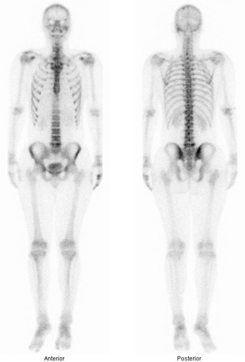 Obr. č. 1: Celotělové scintigramy skeletu v přední a zadní projekci
