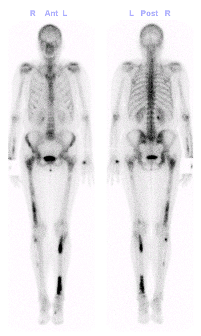 Obr. č. 2: Celotělová scinti skeletu v kostní fázi – ložiska zvýšené kostí přestavby ve výše uvedených lokalizacích.
