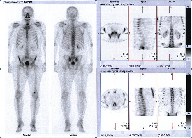 Obr.č.1: : Celotělová scintigrafie skeletu v přední a zadní projekci doplněná o tomografickou scintigrafii (SPECT) bederní a dolní hrudní páteře.