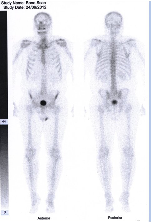 Obr. č. 2: Celotělová scintigrafie skeletu v přední a zadní projekci.