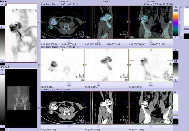 Obr..2: Fze obraz SPECT a CT. Zameno na velk loisko v laterokraniln sti lopaty prav kosti kyeln. ezy transverzln, ezy sagitln a ezy koronln.