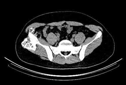 Obr.3: low dose CT pnve  transverzln ez.