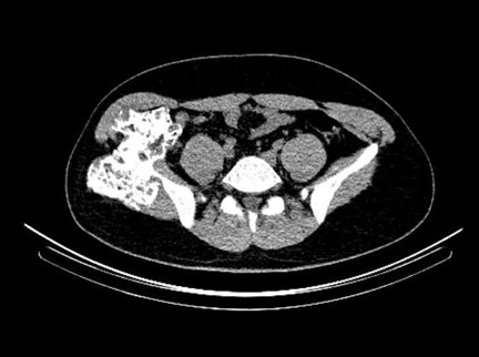 Obr. . 4: low dose CT pnve  transverzln ez.