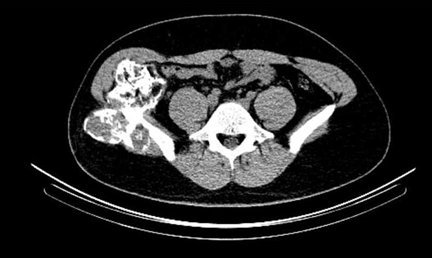 Obr. . 5: low dose CT pnve  transverzln ez.