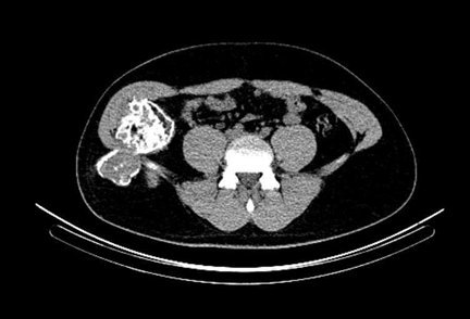 Obr. . 6: low dose CT pnve  transverzln ez.