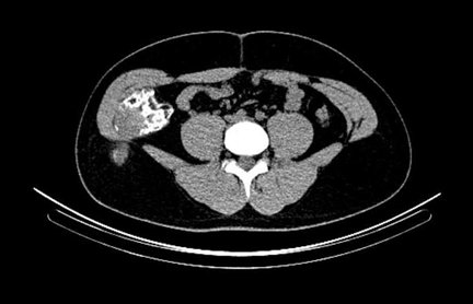 Obr. . 7: low dose CT pnve  transverzln ez.