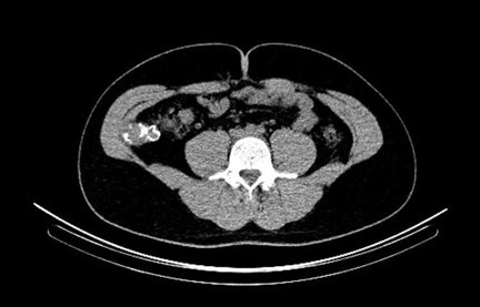 Obr. . 8: low dose CT pnve  transverzln ez.