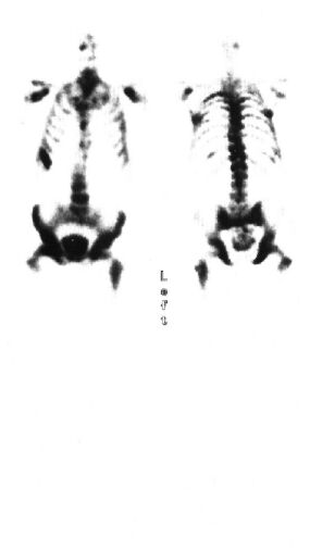 TechneScan HDP: scintigrafie skeletu